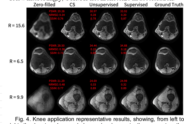 Figure 4 for Unsupervised MRI Reconstruction with Generative Adversarial Networks