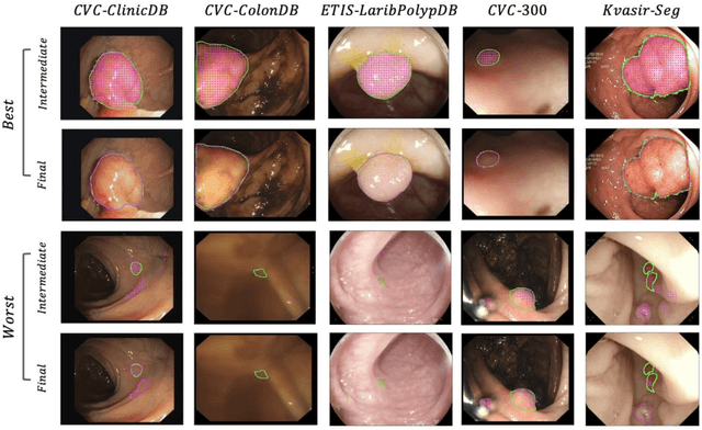 Figure 4 for Advances in Artificial Intelligence to Reduce Polyp Miss Rates during Colonoscopy