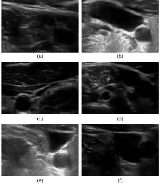 Figure 1 for Adaptive Polar Active Contour for Segmentation and Tracking in Ultrasound Videos