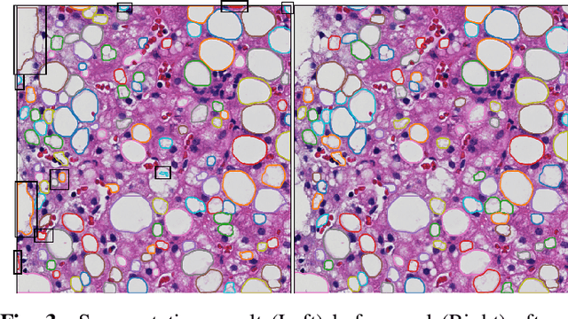 Figure 4 for Liver Steatosis Segmentation with Deep Learning Methods