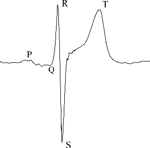 Figure 2 for Discovery of Important Subsequences in Electrocardiogram Beats Using the Nearest Neighbour Algorithm
