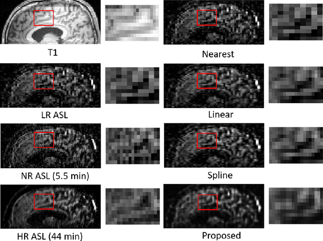 Figure 3 for Super Resolution of Arterial Spin Labeling MR Imaging Using Unsupervised Multi-Scale Generative Adversarial Network