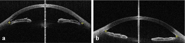 Figure 1 for Identification of primary angle-closure on AS-OCT images with Convolutional Neural Networks