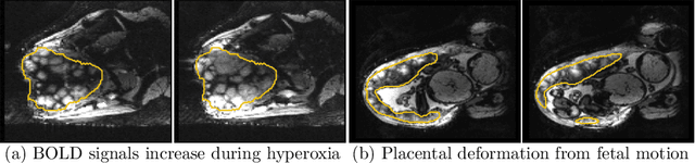 Figure 1 for Automatic Segmentation of the Placenta in BOLD MRI Time Series