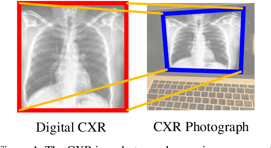 Figure 1 for Projective Transformation Rectification for Camera-captured Chest X-ray Photograph Interpretation with Synthetic Data