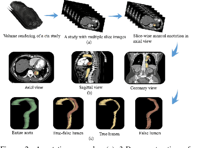 Figure 2 for Towards Personalized Management of Type B Aortic Dissection Using STENT: a STandard cta database with annotation of the ENtire aorta and True-false lumen