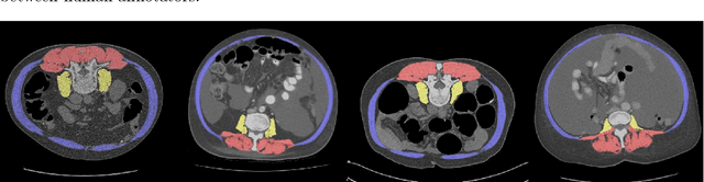 Figure 3 for Fully-automated deep learning slice-based muscle estimation from CT images for sarcopenia assessment