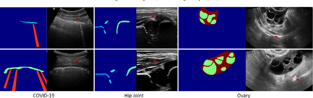 Figure 1 for Sketch guided and progressive growing GAN for realistic and editable ultrasound image synthesis