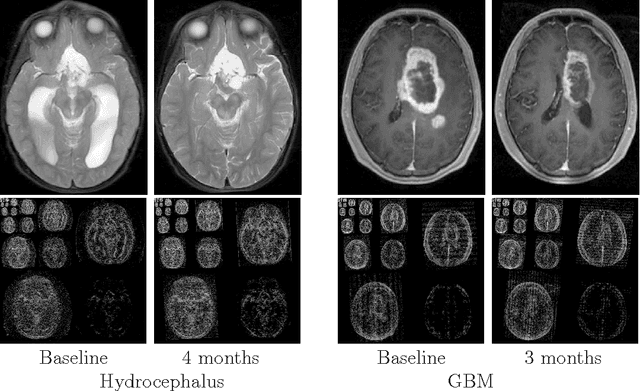 Figure 3 for Compressed sensing for longitudinal MRI: An adaptive-weighted approach