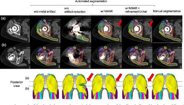 Figure 4 for Automated Segmentation of Hip and Thigh Muscles in Metal Artifact-Contaminated CT using Convolutional Neural Network-Enhanced Normalized Metal Artifact Reduction