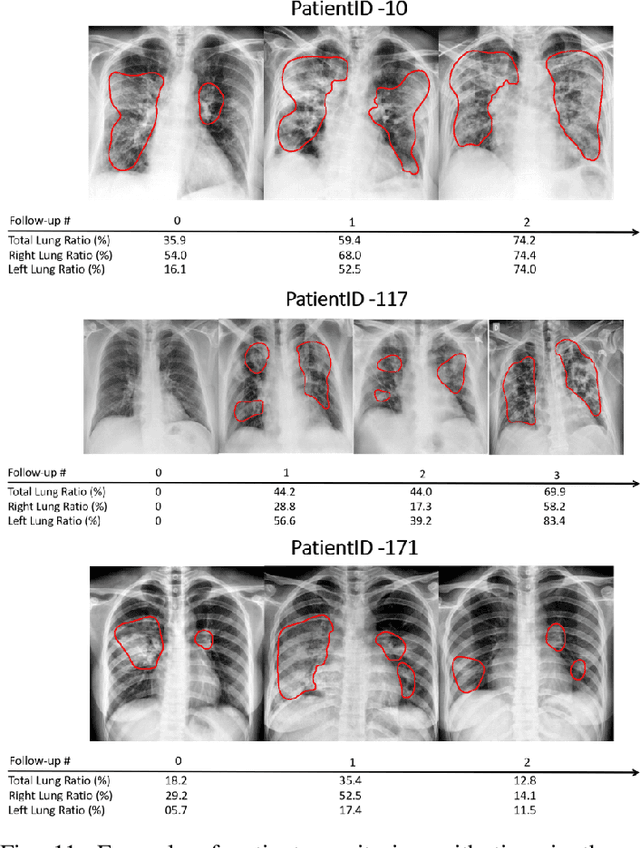Figure 3 for COVID-19 in CXR: from Detection and Severity Scoring to Patient Disease Monitoring
