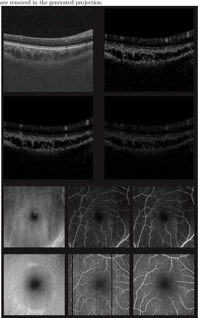 Figure 3 for Deep OCT Angiography Image Generation for Motion Artifact Suppression