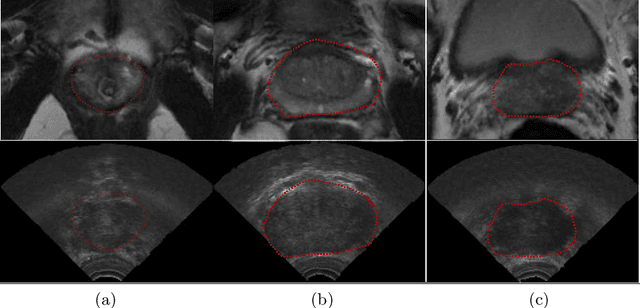 Figure 1 for Automatic Segmentation of the Prostate on 3D Trans-rectal Ultrasound Images using Statistical Shape Models and Convolutional Neural Networks
