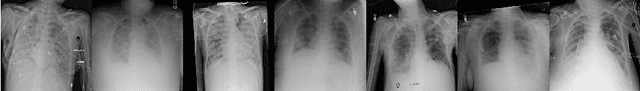 Figure 1 for Endotracheal Tube Detection and Segmentation in Chest Radiographs using Synthetic Data