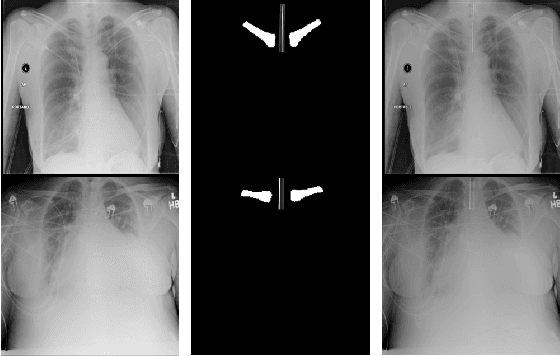 Figure 3 for Endotracheal Tube Detection and Segmentation in Chest Radiographs using Synthetic Data