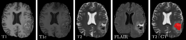 Figure 1 for Uncertainty-driven Sanity Check: Application to Postoperative Brain Tumor Cavity Segmentation