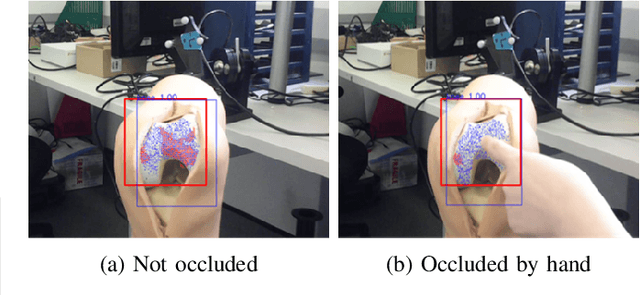 Figure 2 for Occlusion-robust Visual Markerless Bone Tracking for Computer-Assisted Orthopaedic Surgery