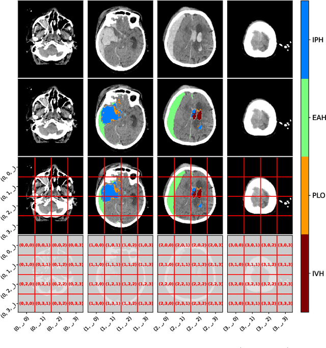 Figure 1 for Automatic lesion analysis for increased efficiency in outcome prediction of traumatic brain injury