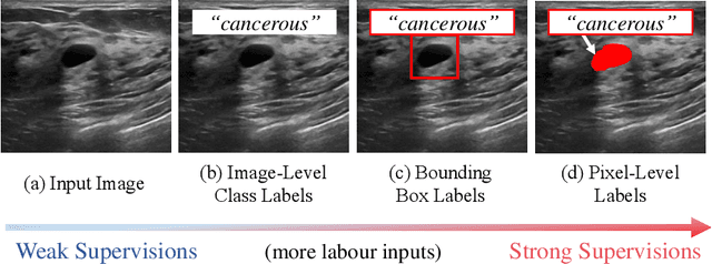Figure 1 for FedMix: Mixed Supervised Federated Learning for Medical Image Segmentation