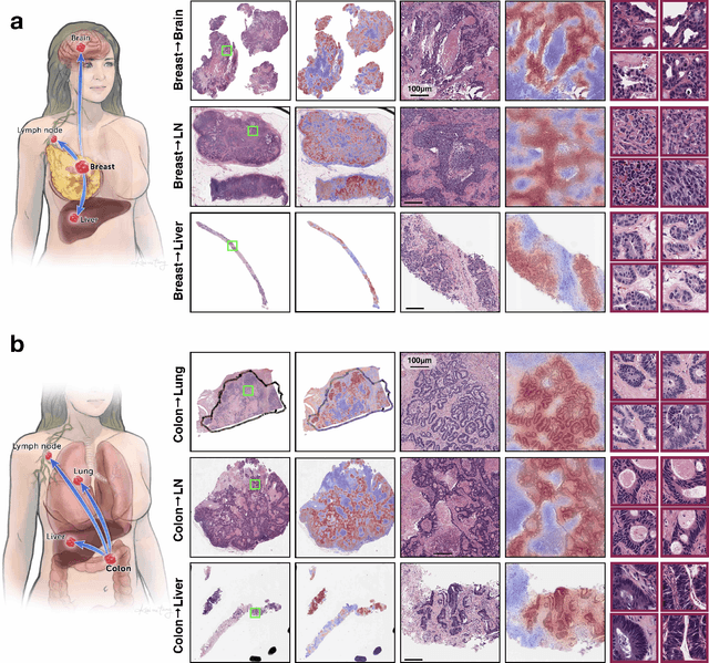 Figure 4 for Deep Learning-based Computational Pathology Predicts Origins for Cancers of Unknown Primary