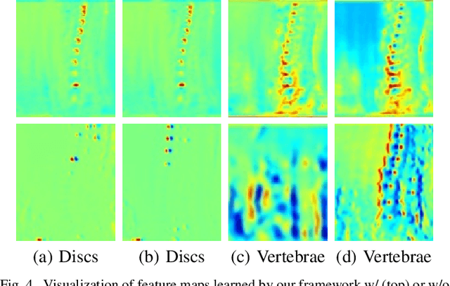 Figure 4 for SpineOne: A One-Stage Detection Framework for Degenerative Discs and Vertebrae