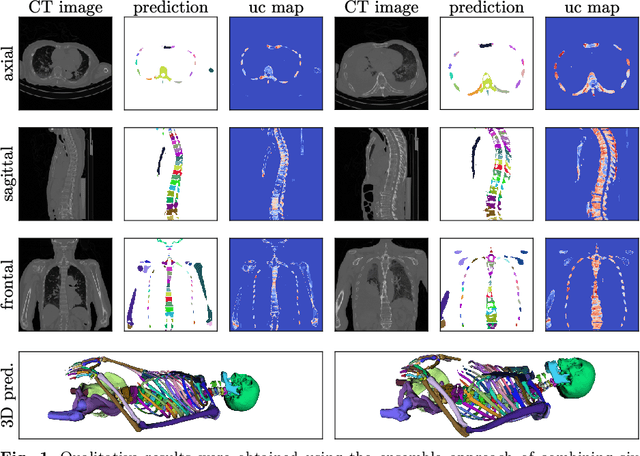 Figure 2 for Ensemble uncertainty as a criterion for dataset expansion in distinct bone segmentation from upper-body CT images