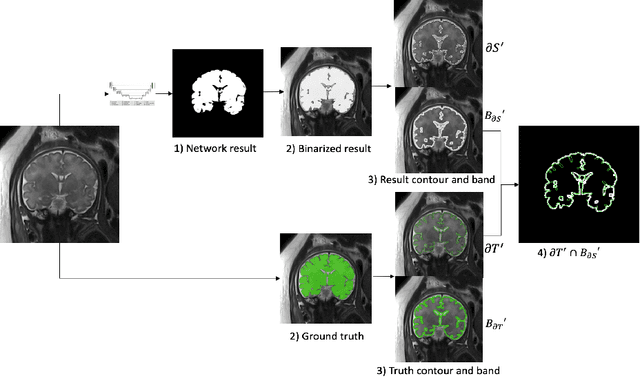 Figure 3 for Contour Dice loss for structures with Fuzzy and Complex Boundaries in Fetal MRI