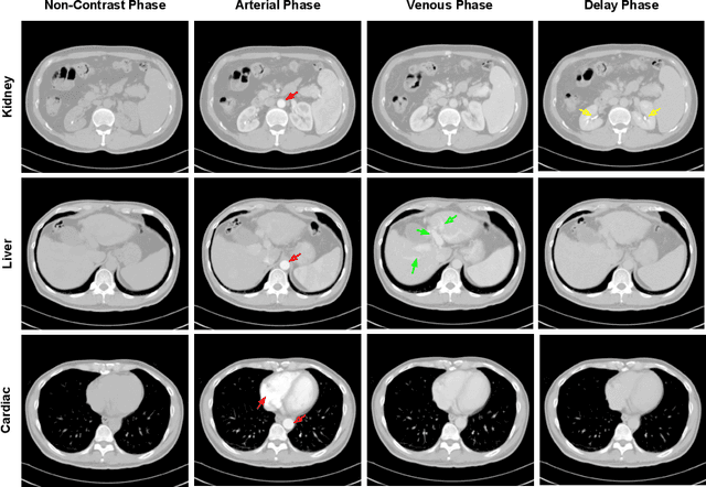 Figure 1 for CT Data Curation for Liver Patients: Phase Recognition in Dynamic Contrast-Enhanced CT