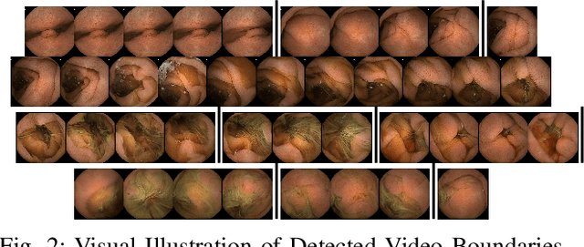 Figure 2 for Graph Convolution Neural Network For Weakly Supervised Abnormality Localization In Long Capsule Endoscopy Videos