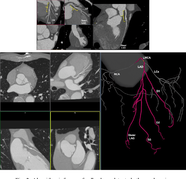 Figure 3 for Artificial Intelligence to Assist in Exclusion of Coronary Atherosclerosis during CCTA Evaluation of Chest-Pain in the Emergency Department: Preparing an Application for Real-World Use