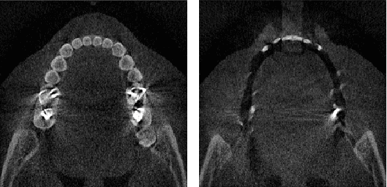 Figure 1 for Unsupervised CT Metal Artifact Learning using Attention-guided beta-CycleGAN