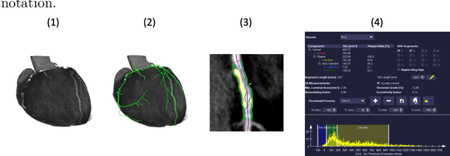 Figure 1 for Coronary Plaque Analysis for CT Angiography Clinical Research