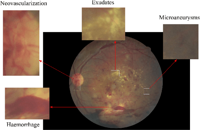 Figure 1 for Deep Learning based Early Detection and Grading of Diabetic Retinopathy Using Retinal Fundus Images