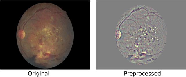 Figure 3 for Deep Learning based Early Detection and Grading of Diabetic Retinopathy Using Retinal Fundus Images