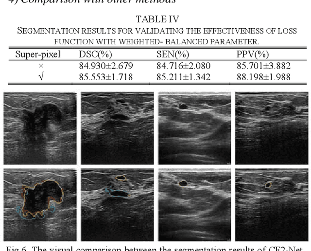 Figure 4 for CF2-Net: Coarse-to-Fine Fusion Convolutional Network for Breast Ultrasound Image Segmentation