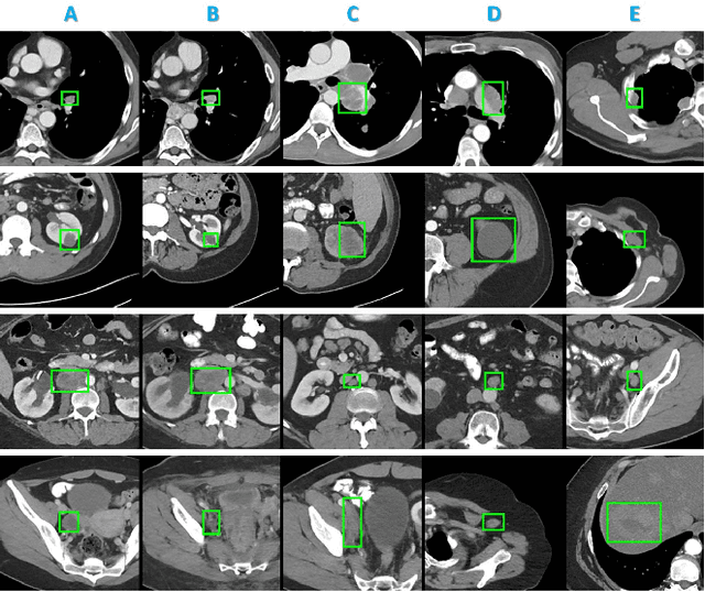 Figure 4 for Deep Lesion Graphs in the Wild: Relationship Learning and Organization of Significant Radiology Image Findings in a Diverse Large-scale Lesion Database