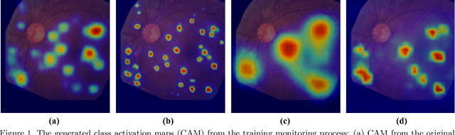Figure 1 for Self-Supervised Equivariant Regularization Reconciles Multiple Instance Learning: Joint Referable Diabetic Retinopathy Classification and Lesion Segmentation