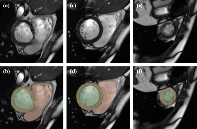 Figure 2 for The Extreme Cardiac MRI Analysis Challenge under Respiratory Motion (CMRxMotion)