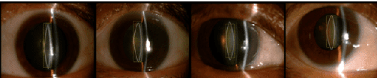 Figure 3 for Machine Learning for Cataract Classification and Grading on Ophthalmic Imaging Modalities: A Survey