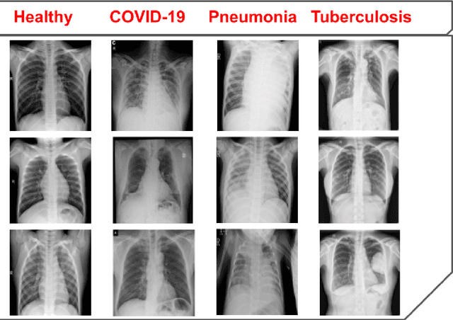 Figure 3 for DenResCov-19: A deep transfer learning network for robust automatic classification of COVID-19, pneumonia, and tuberculosis from X-rays