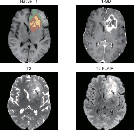 Figure 1 for Extending nn-UNet for brain tumor segmentation