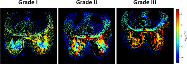 Figure 1 for Cancer-Net BCa-S: Breast Cancer Grade Prediction using Volumetric Deep Radiomic Features from Synthetic Correlated Diffusion Imaging