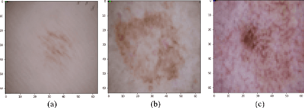 Figure 3 for The Forward-Forward Algorithm as a feature extractor for skin lesion classification: A preliminary study