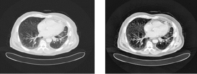 Figure 3 for Deep Learning Approach for Early Stage Lung Cancer Detection