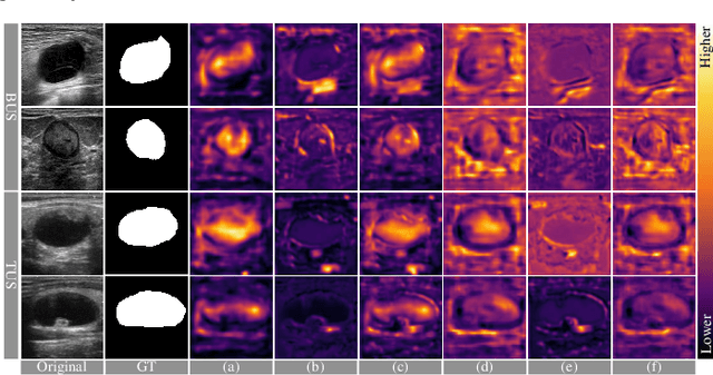 Figure 4 for Decomposing and Coupling Saliency Map for Lesion Segmentation in Ultrasound Images