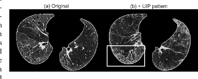Figure 3 for Less is More: Unsupervised Mask-guided Annotated CT Image Synthesis with Minimum Manual Segmentations