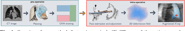 Figure 1 for CNN-based real-time 2D-3D deformable registration from a single X-ray projection