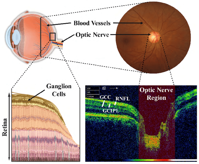 Figure 1 for Deep Learning and Computer Vision for Glaucoma Detection: A Review