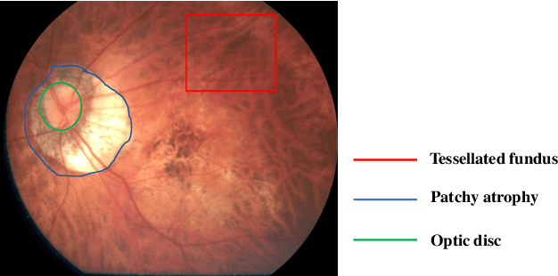 Figure 1 for Efficient Pyramid Channel Attention Network for Pathological Myopia Detection