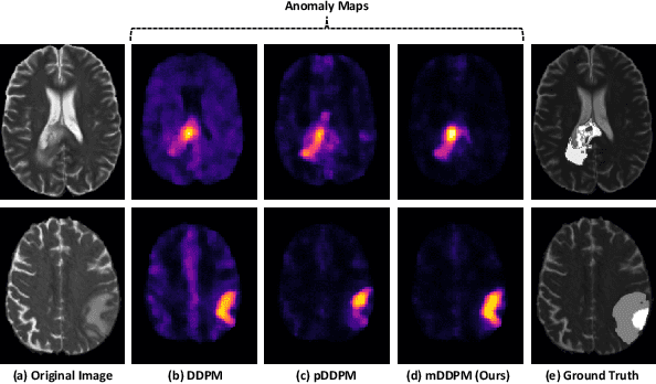Figure 3 for Unsupervised Anomaly Detection in Medical Images Using Masked Diffusion Model